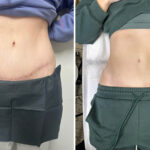 What Is Scar Camouflage?