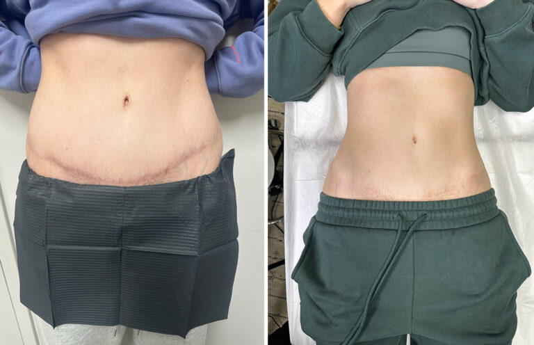 What Is Scar Camouflage?