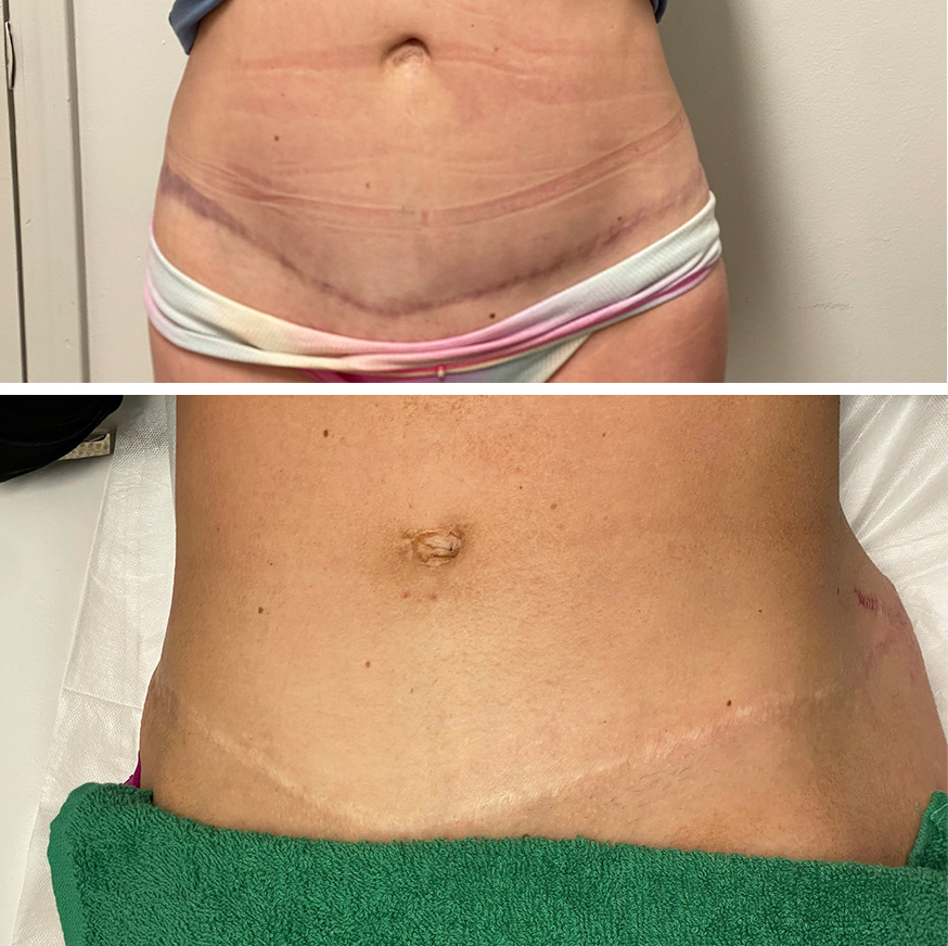 Why You Should Always Ask for Before and After Photos Before Trusting a Scar Camouflage Artist