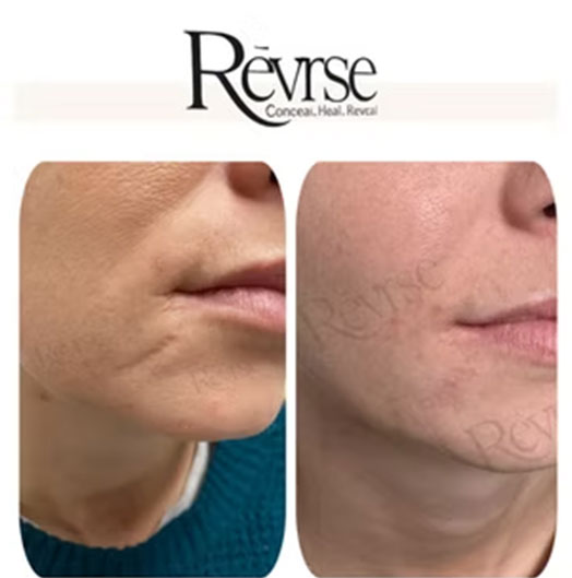 Makeup vs Scar Camouflage in Fishers – What’s The Best?