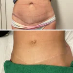 Top 5 Things to Know Before Getting a Scar Camouflage Treatment