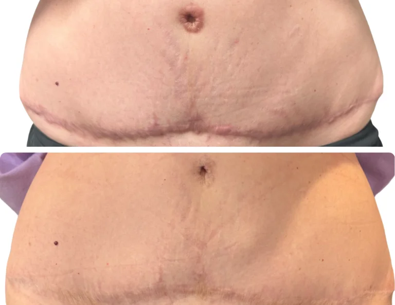 Scar Camouflage Gallery Image