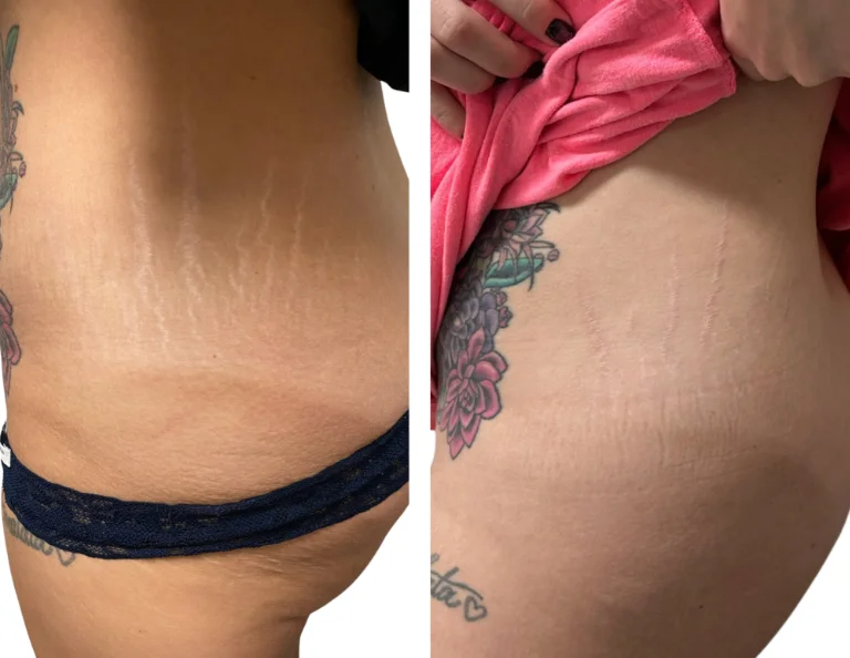 Stretch Mark Revision Gallery Image