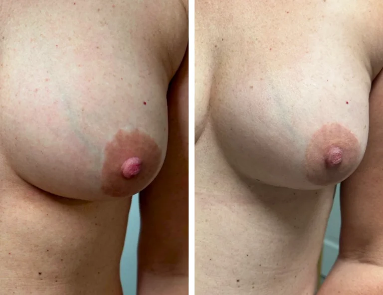 Areola Restoration & Balancing Gallery Image