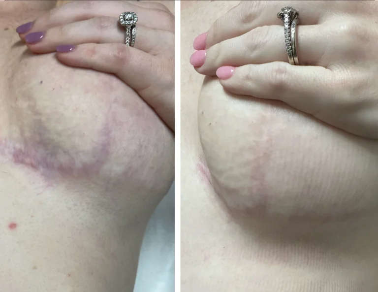 Inkless Scar Revision Gallery Image