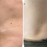 Why Medical Tattooing in Fishers is Life Changing