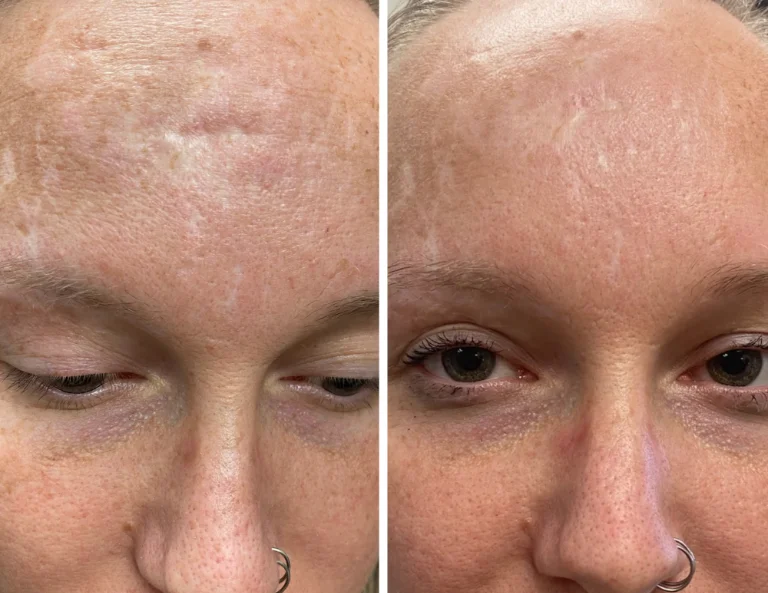 Inkless Scar Revision Gallery Image