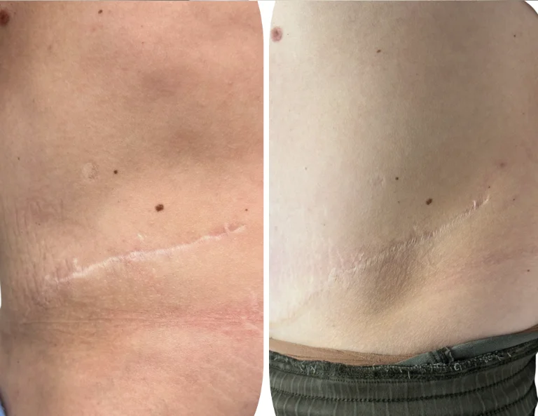 Why Medical Tattooing in Fishers is Life Changing