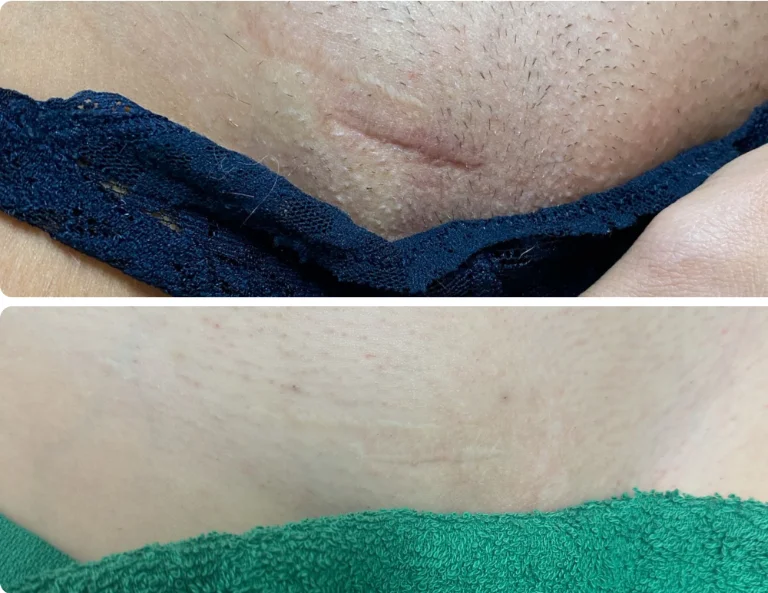 Inkless Scar Revision Gallery Image