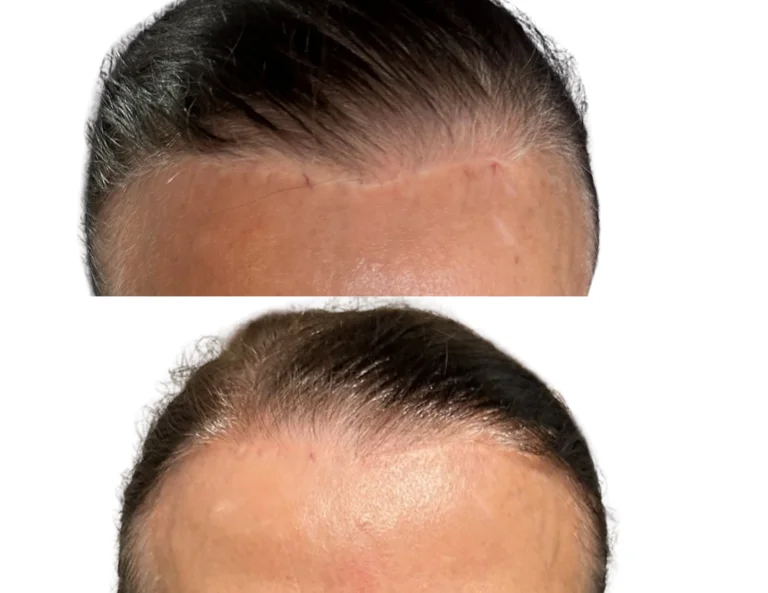 Scar Camouflage Gallery Image