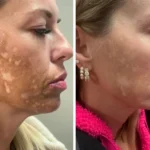 Scar Camouflage vs. Microneedling: What’s the Difference?