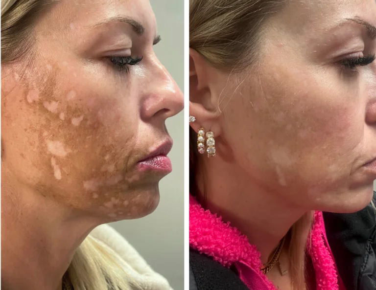 Scar Camouflage Gallery Image