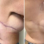 Why Your Scar Needs Multiple Sessions (And Why That’s A Good Thing)