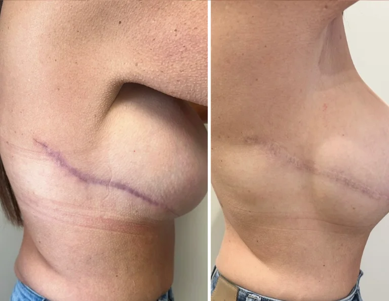 Scar Camouflage Gallery Image