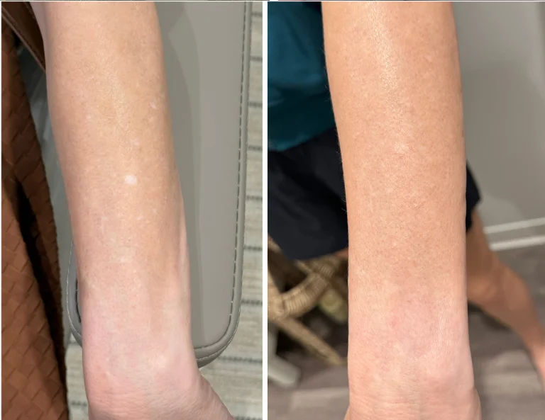 Scar Camouflage Gallery Image