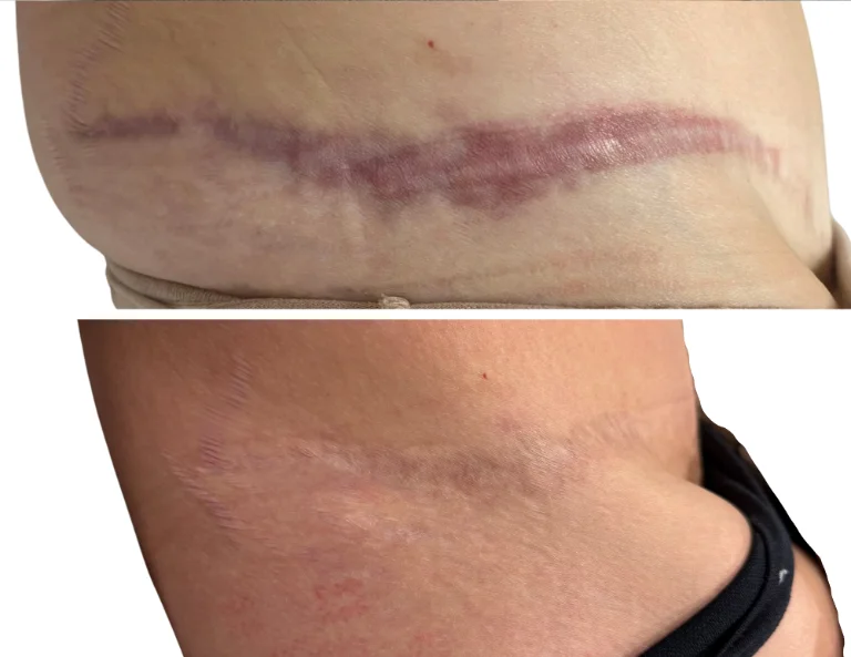 Scar Camouflage Gallery Image