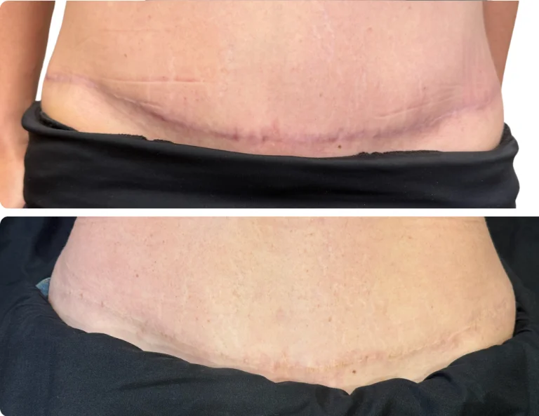 Scar Camouflage Gallery Image