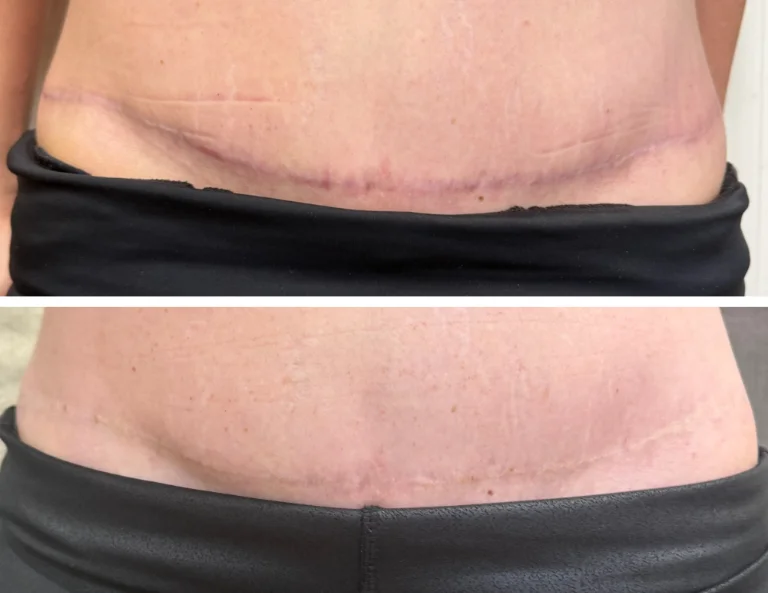 Scar Camouflage Gallery Image