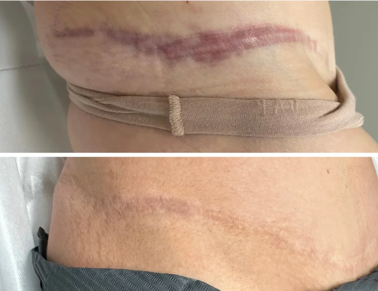 Scar Camouflage Gallery Image