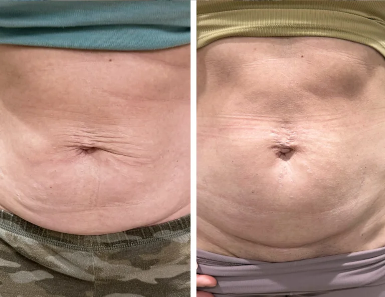 Skin Tightening & Lifting Gallery Image