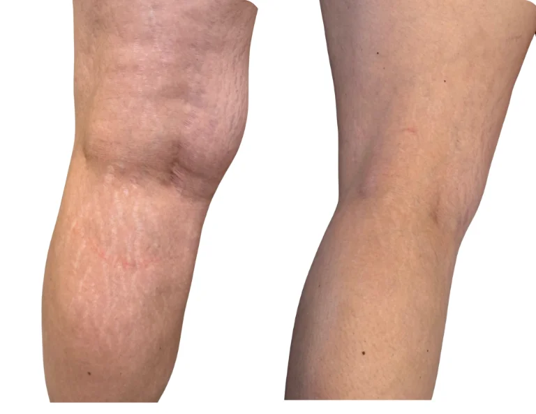 Stretch Mark Revision Gallery Image