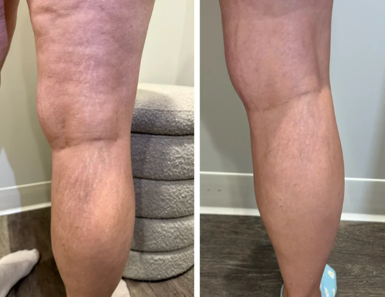 Stretch Mark Revision Gallery Image