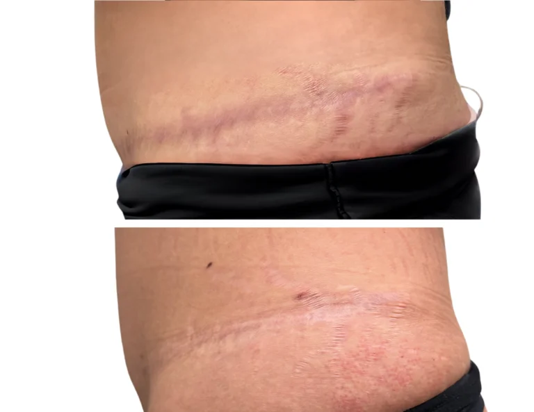 Stretch Mark Revision Gallery Image