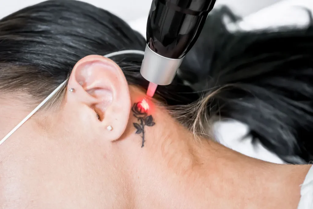Secrets Professionals Use for Tattoo Removal in Indiana