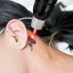 Secrets Professionals Use for Tattoo Removal in Indiana
