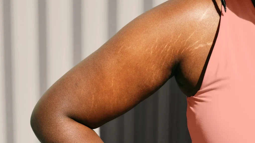 Before You Try Stretch Mark Camouflage Read This…