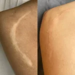 Medical Tattooing Fishers – Before & After Guide