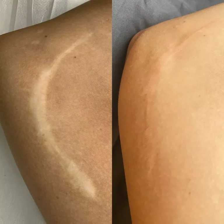 Medical Tattooing Fishers – Before & After Guide