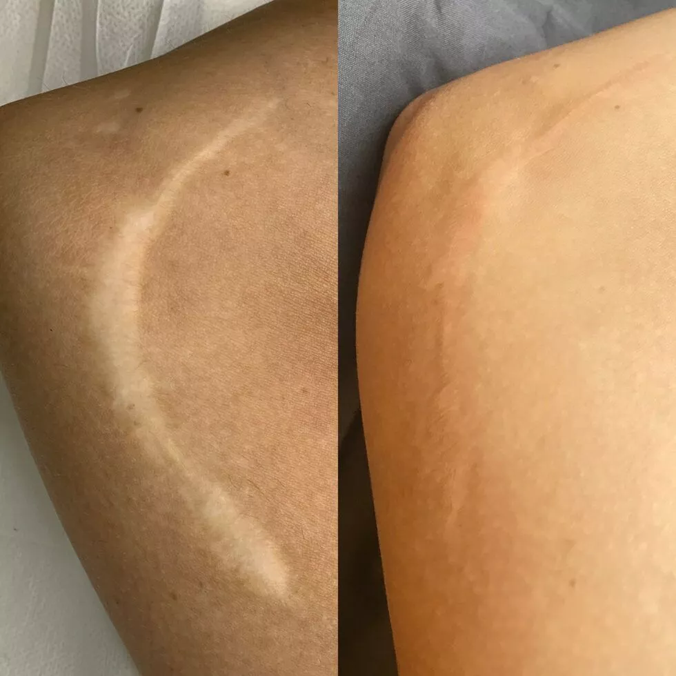 Medical Tattooing Fishers – Before & After Guide