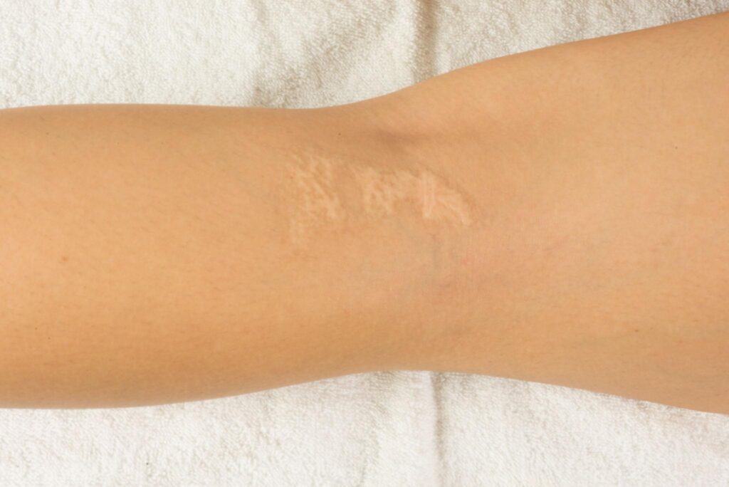 Why Scar Tattooing Beats Creams Every Time