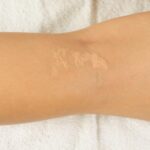 Why Scar Tattooing Beats Creams Every Time